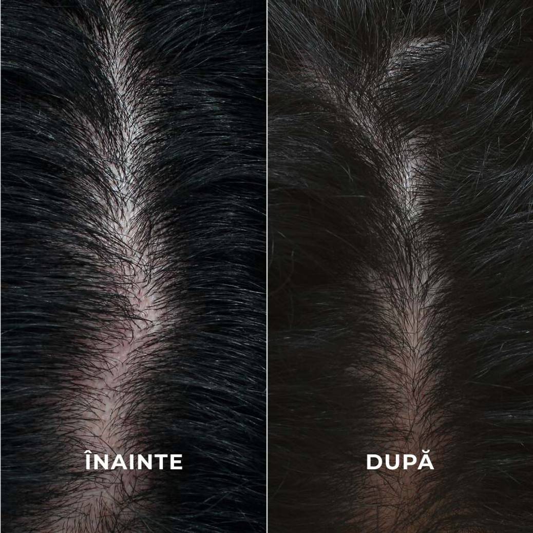 Cură intensivă pentru creșterea densității părului
